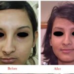 Face Lift