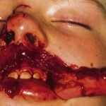 Soft Tissue Injury